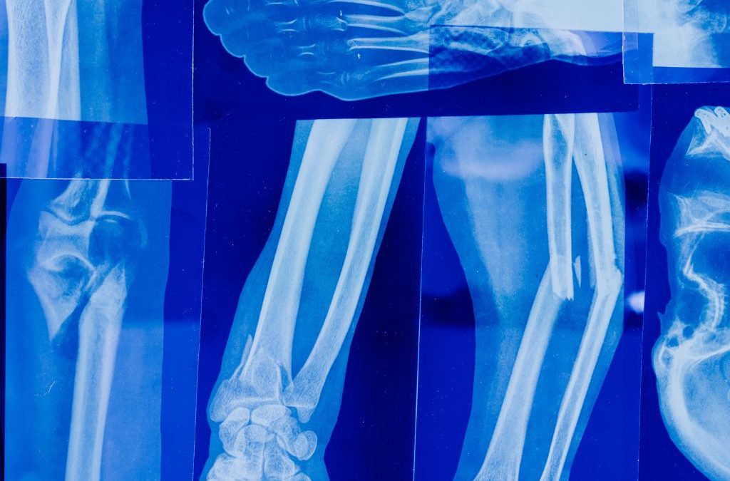Día 13 de julio: Día Internacional del Sarcoma