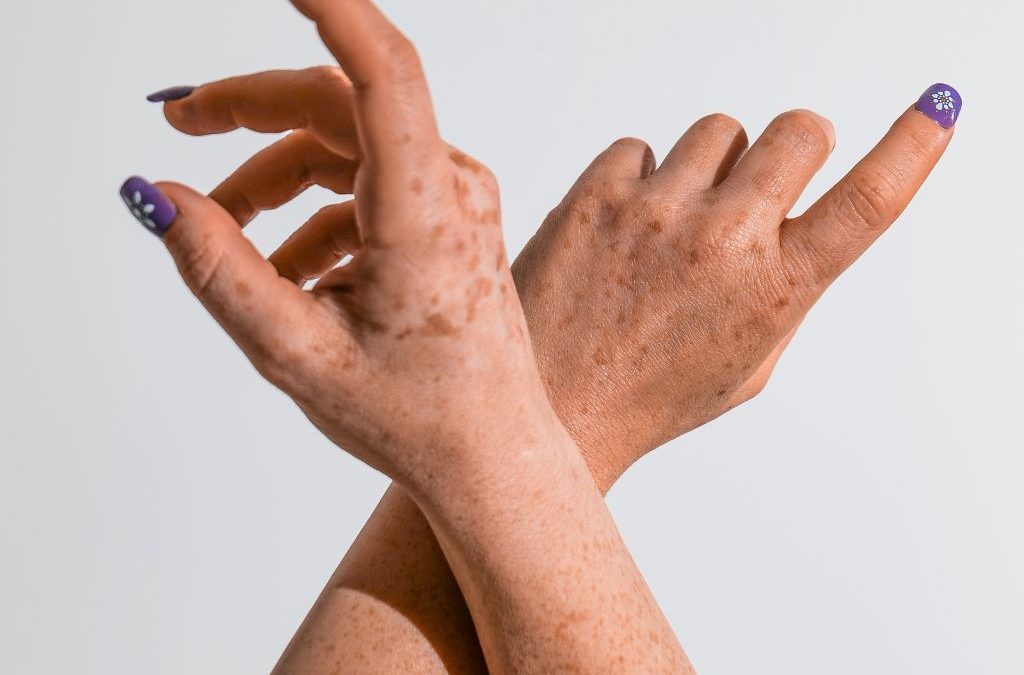 Día 14 de septiembre: Día Mundial de la Dermatitis Atópica